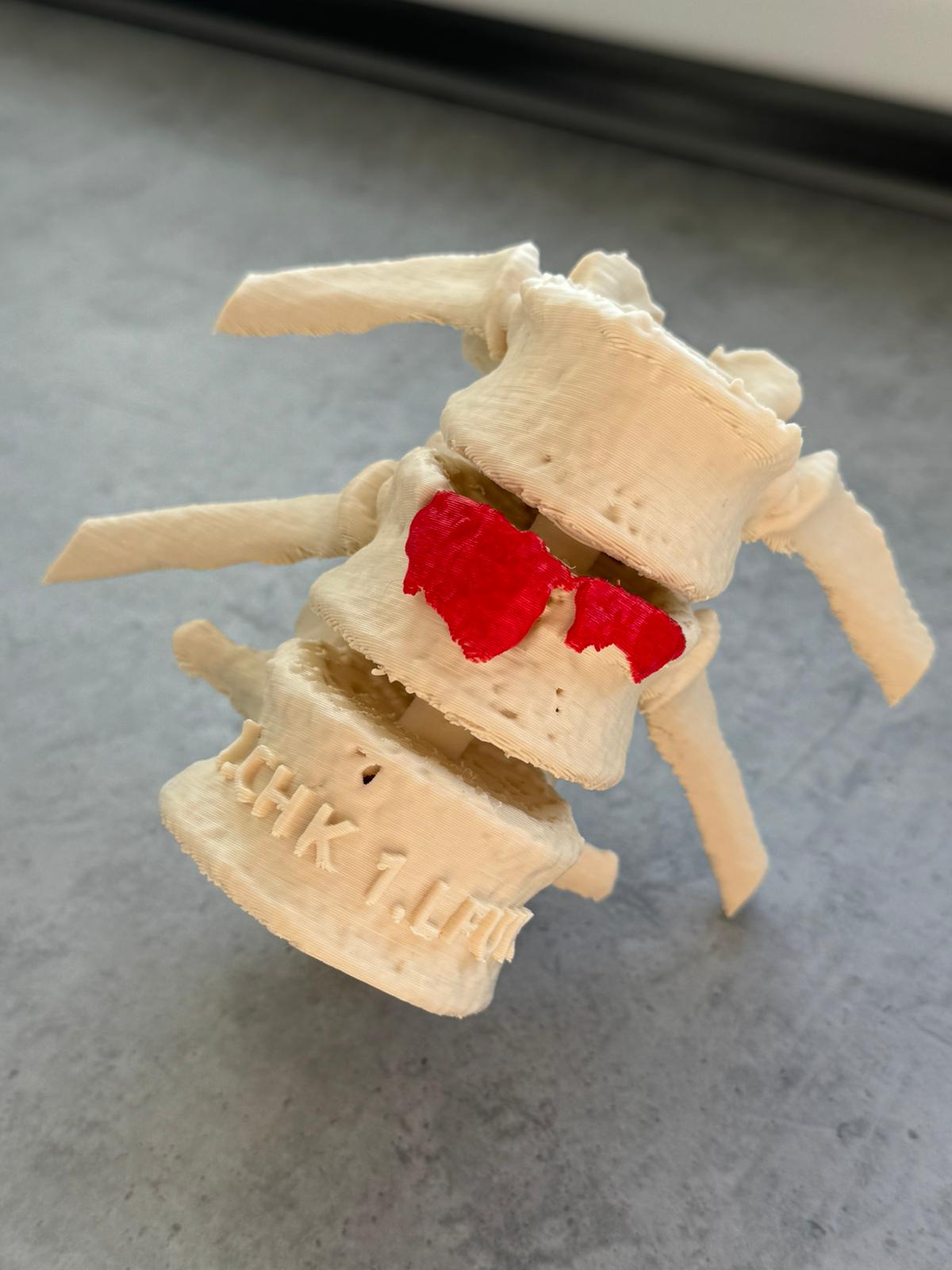 Vertebral fracture / zlomenina obratle