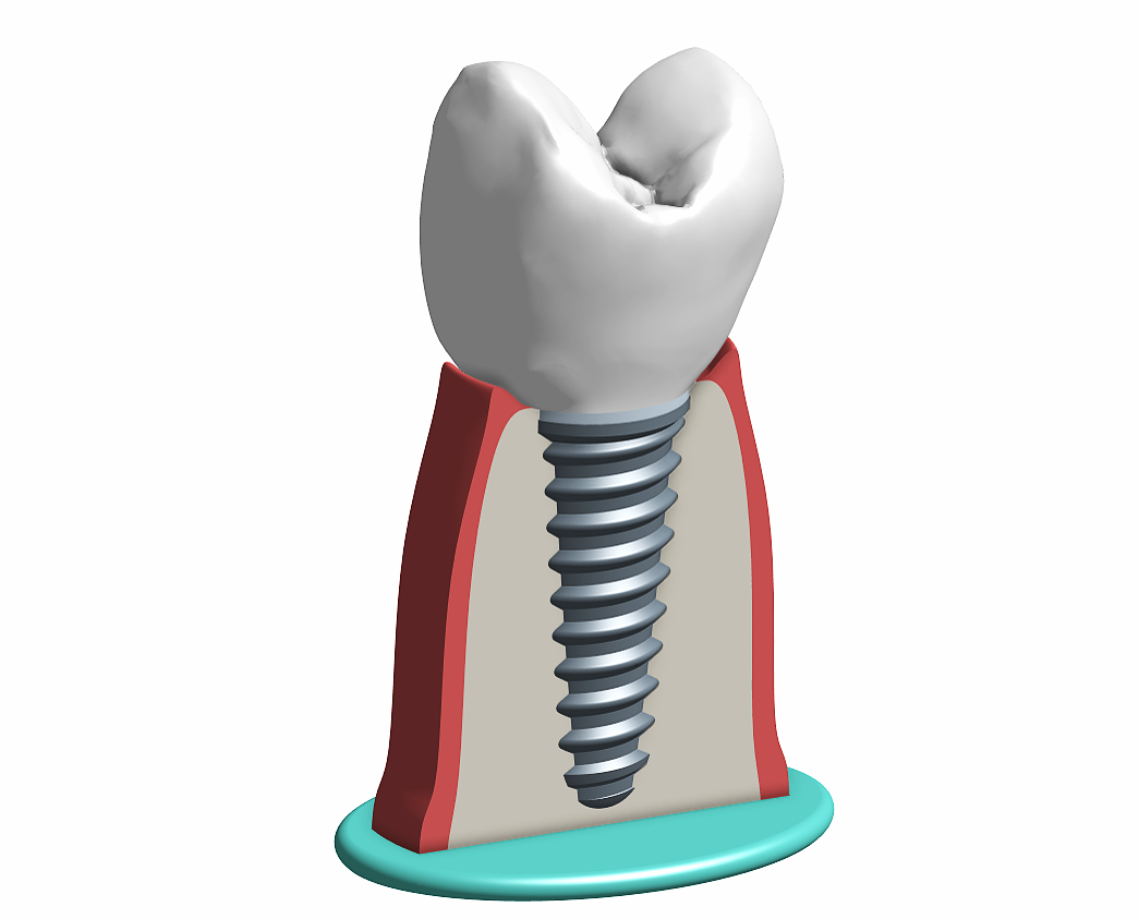 Miniatura 9 do modelo 3D Tooth implant model