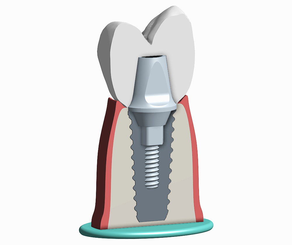 Miniatura 8 do modelo 3D Tooth implant model
