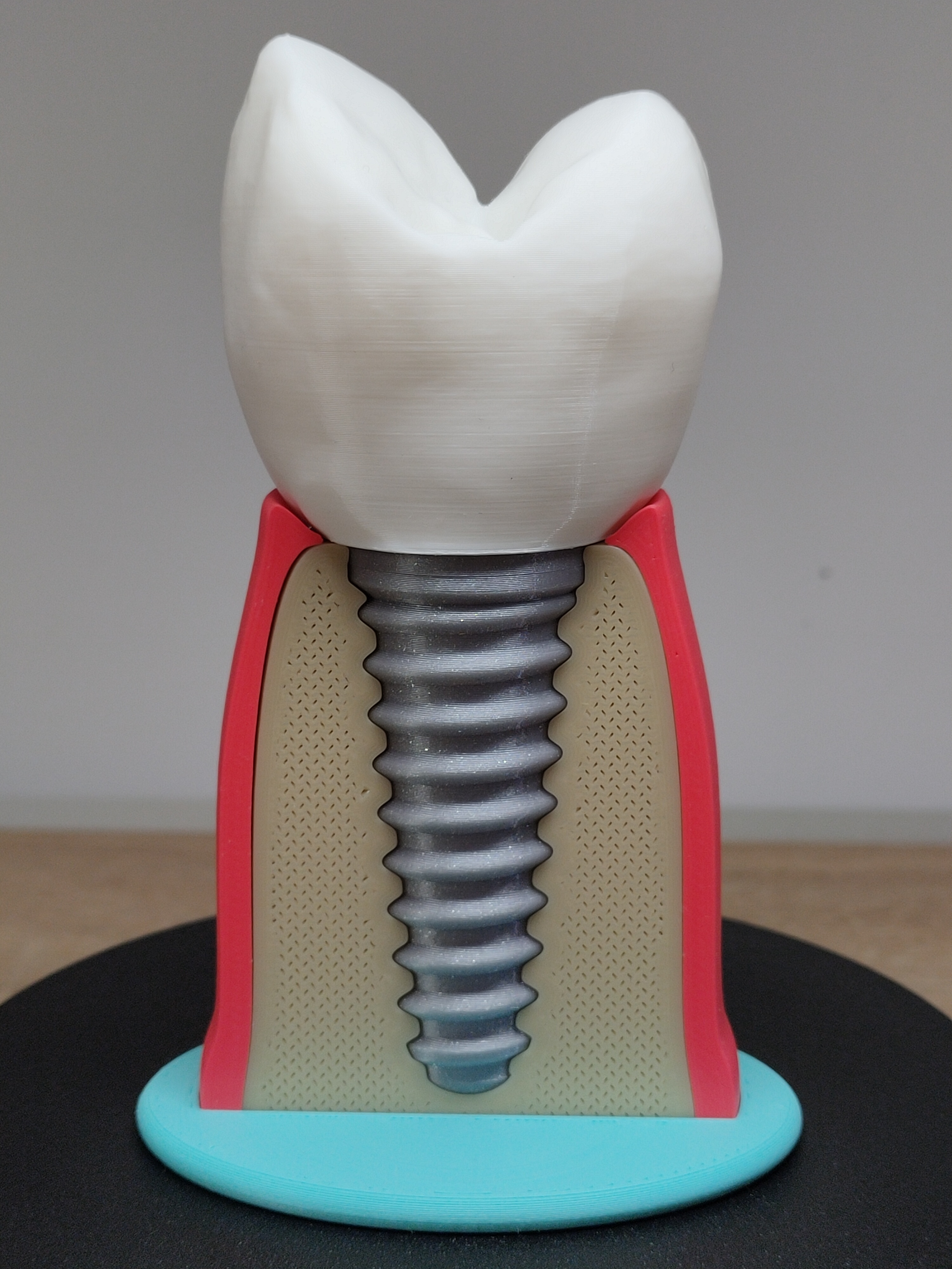 Miniatura 11 do modelo 3D Tooth implant model