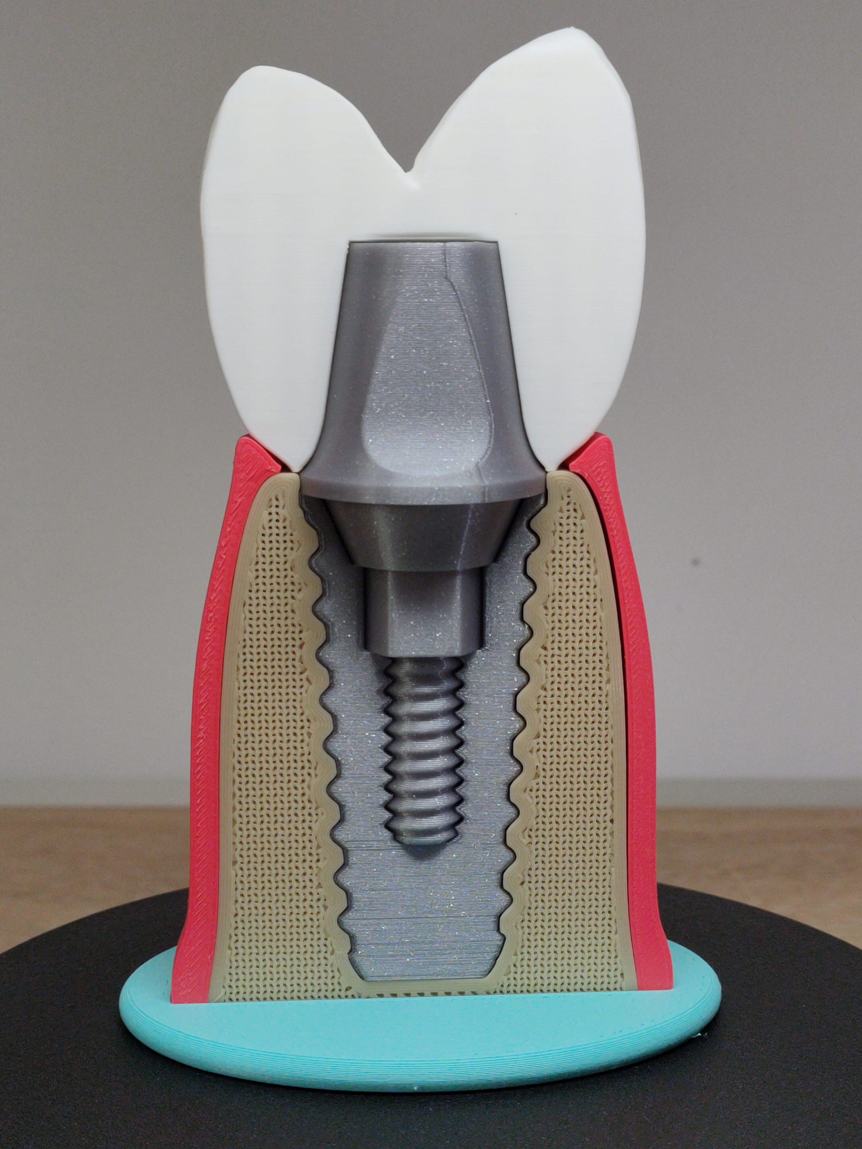 Miniatura 6 do modelo 3D Tooth implant model