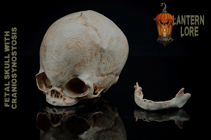 Fetal Skull with Craniosynostosis (Pre Supported)