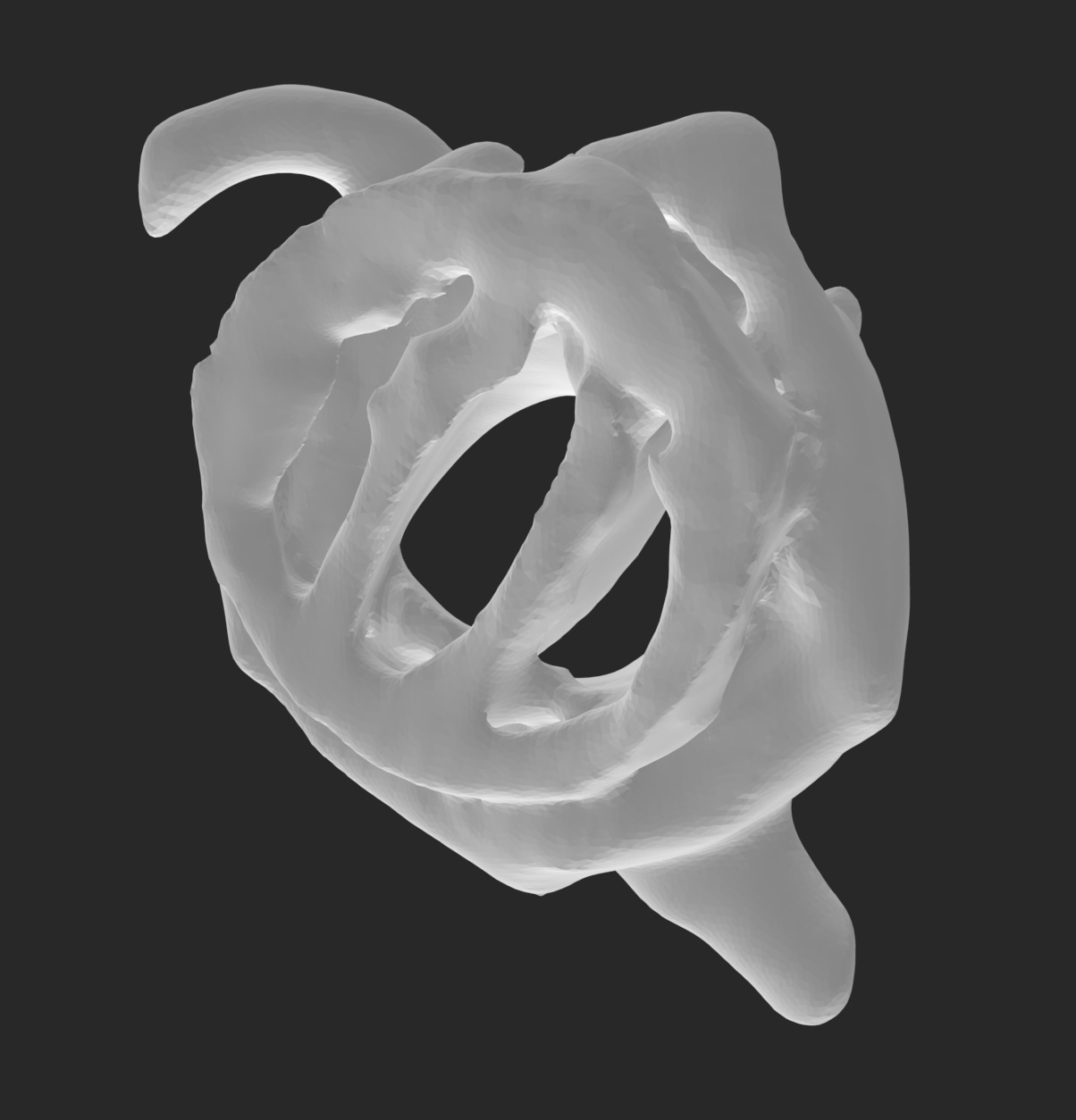 Pseudoaneurysm anatomical