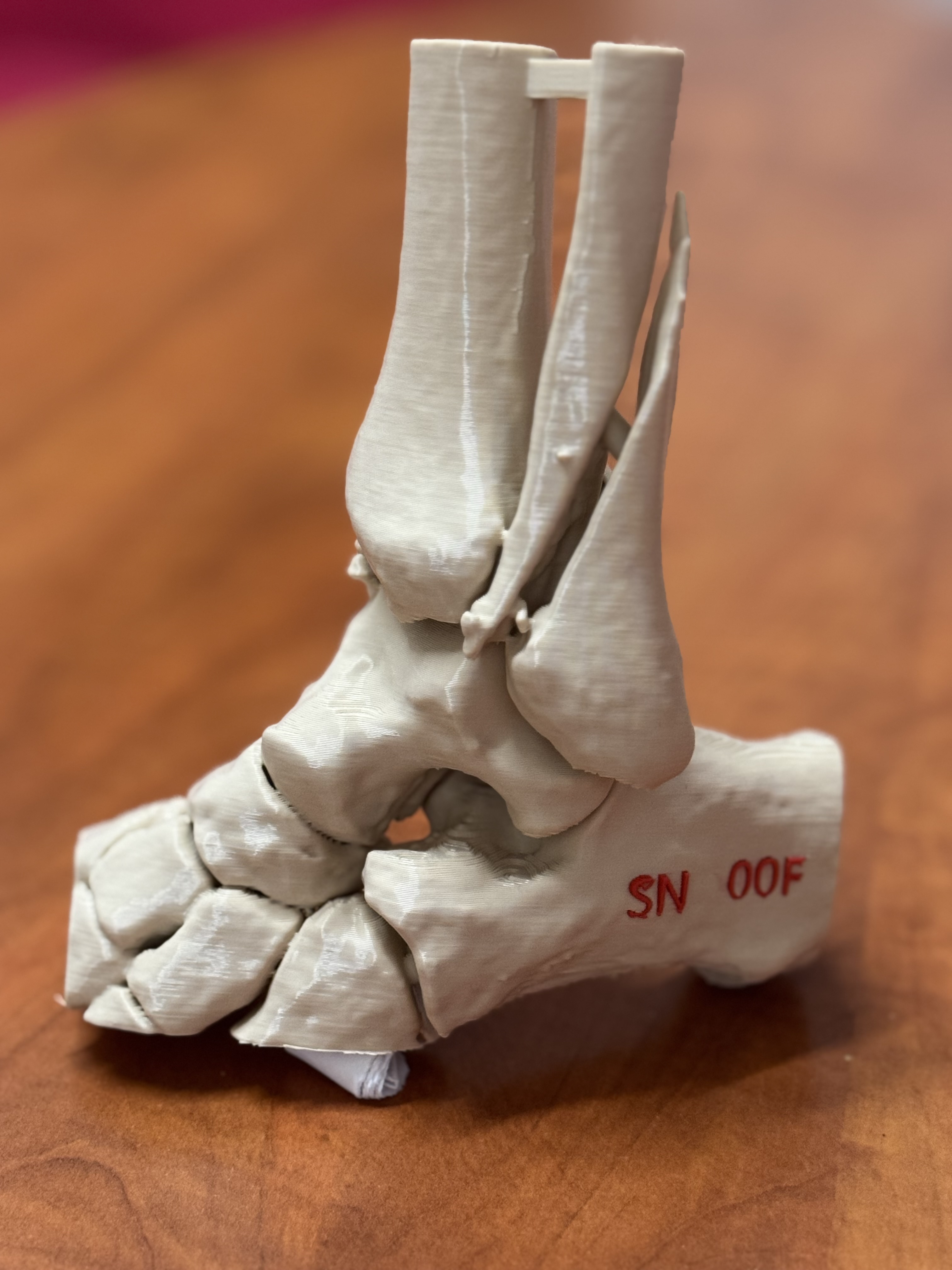 Trimalleolar Fracture (44B3.2 AO Classification)