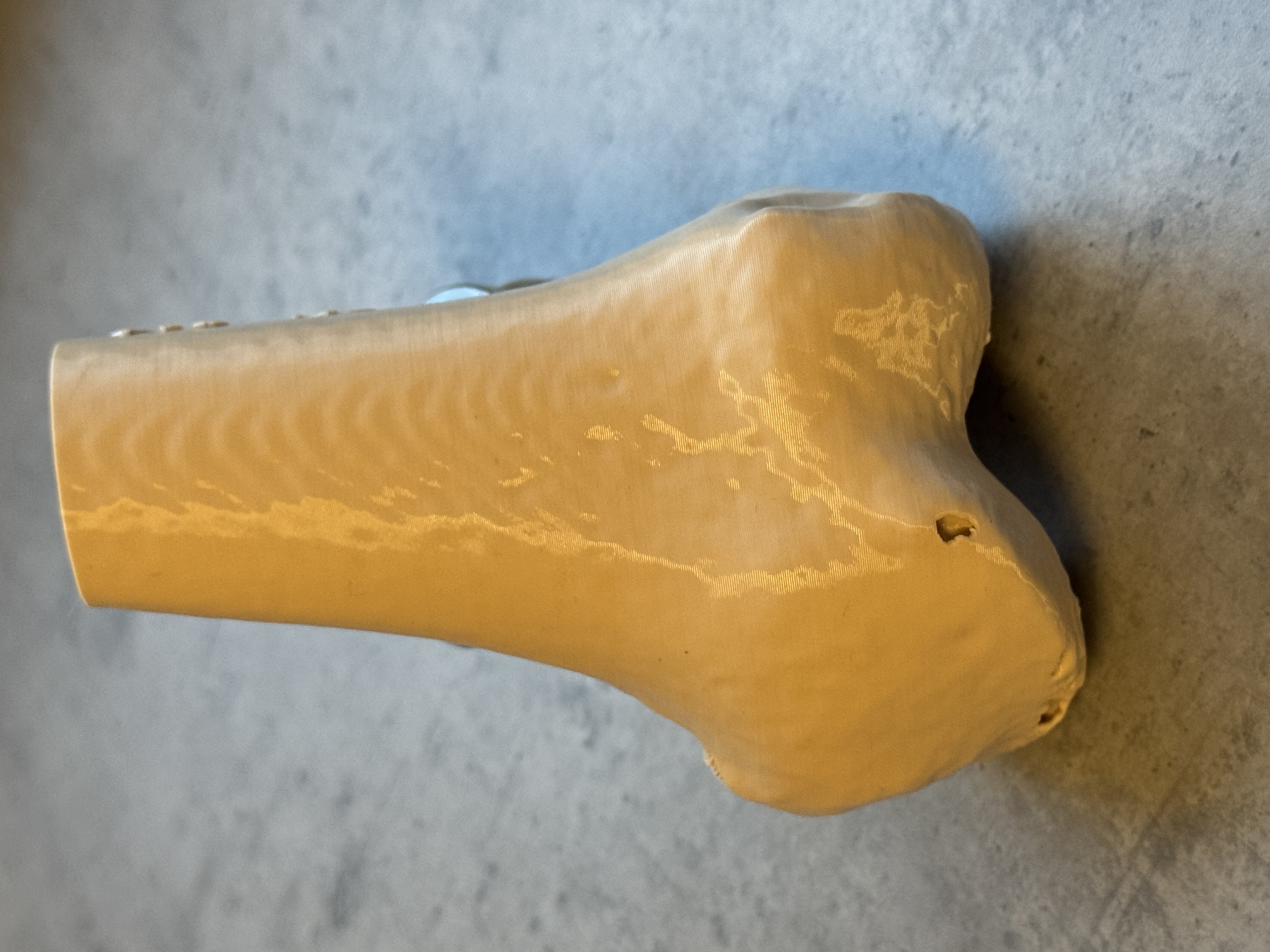 Distal femur