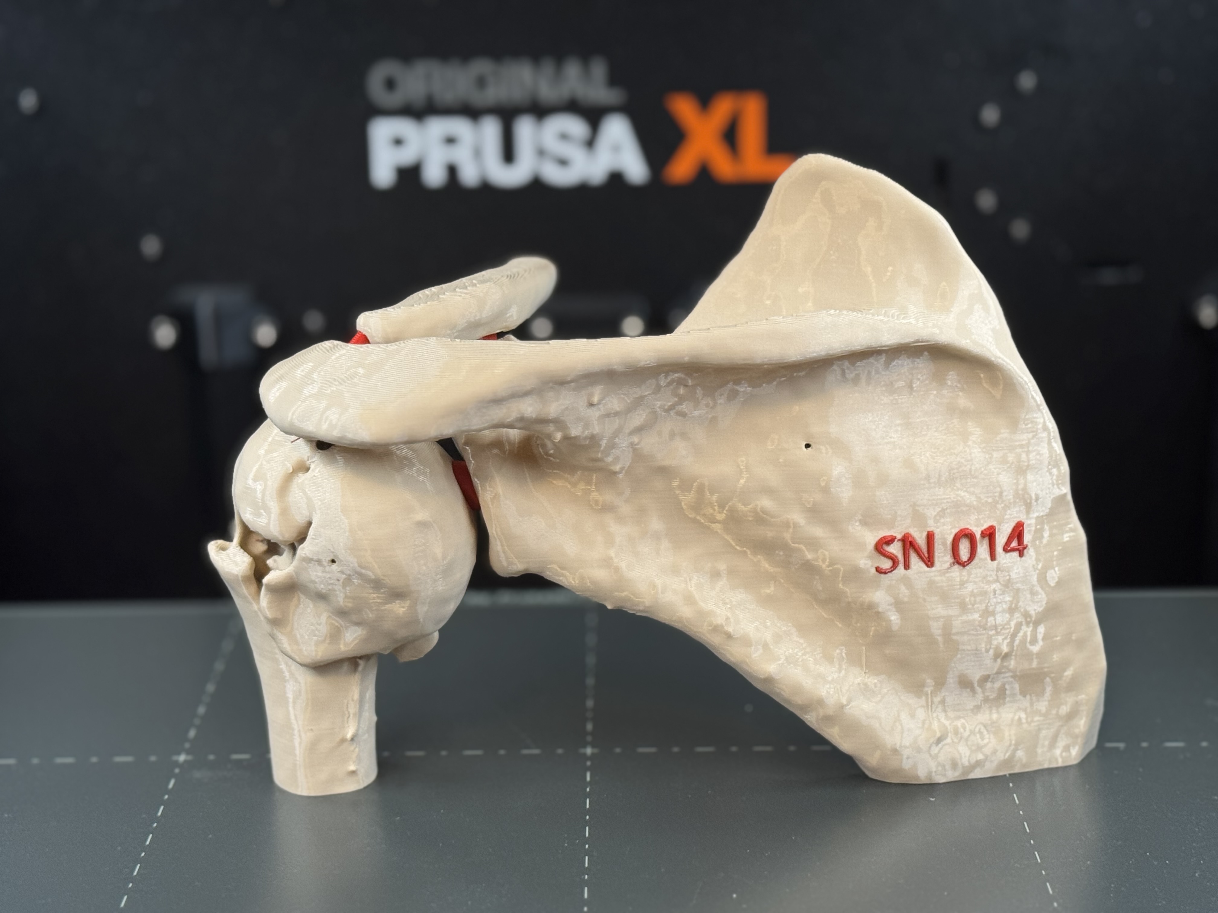 Proximal humerus fracture (AO classifiacation 11B1.1)