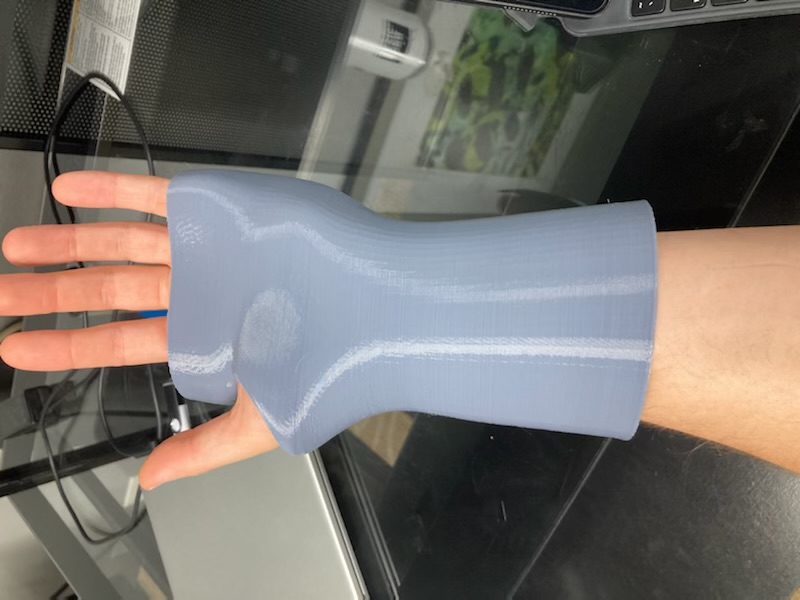 wrist splint volar based by Bcare001 Download free STL model