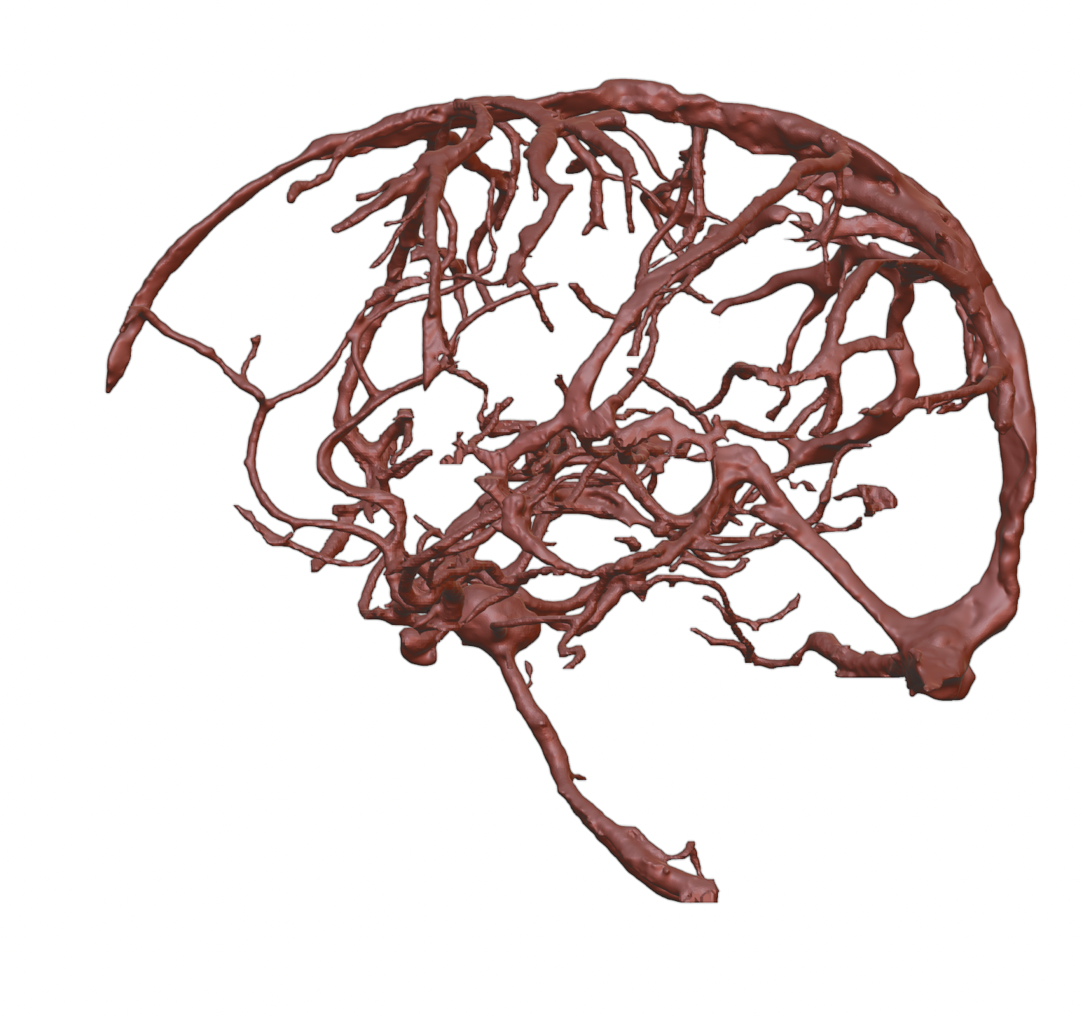 Brain arteries with aneurysm