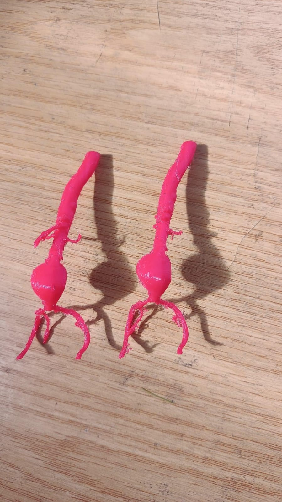 Abdominal Aortic Aneurysm (AAA) - 1:1 Anatomical Scale