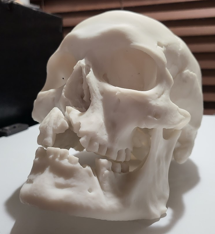 "Cranium with Injuries", a 661 year old skull, 3d scanned, and repaired for printing