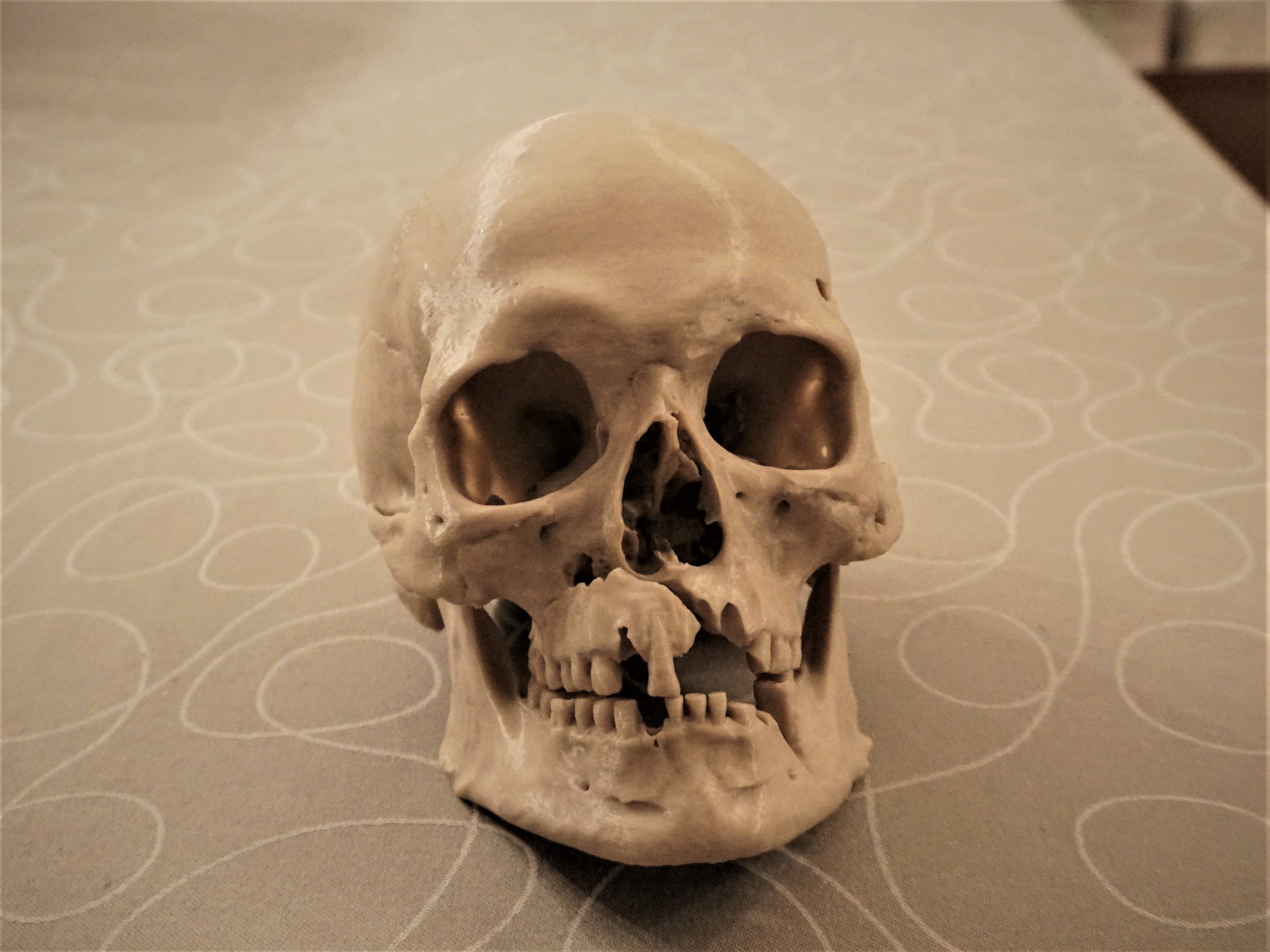 Human Skull with battle injuries (3D scan; Historiska Museet 260727)