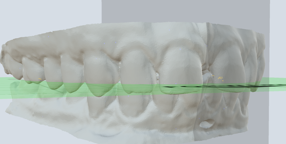 dental model of complete arch