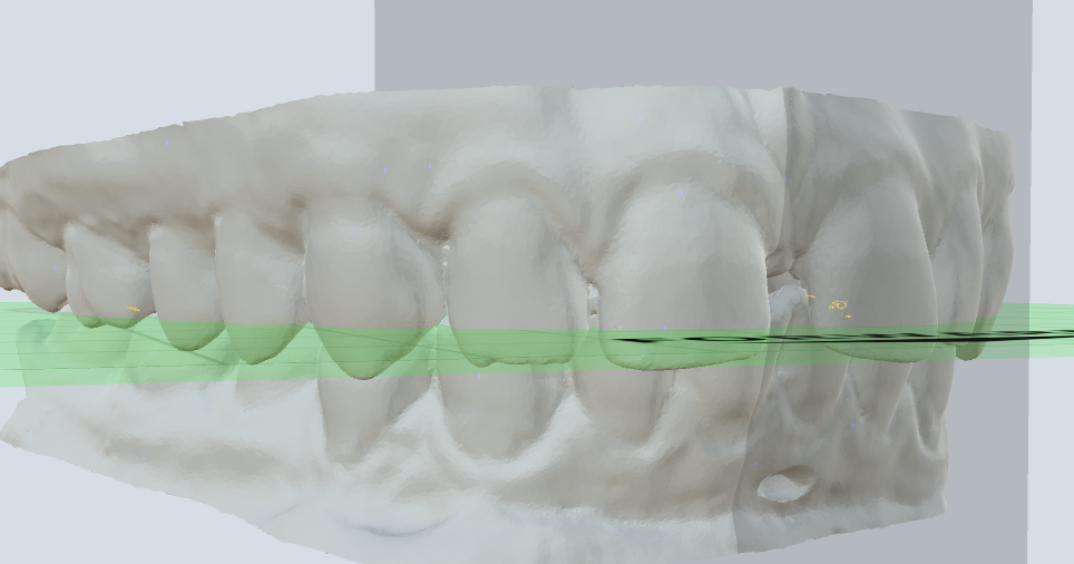 Dental Model Of Complete Arch By Joje | Download Free STL Model ...