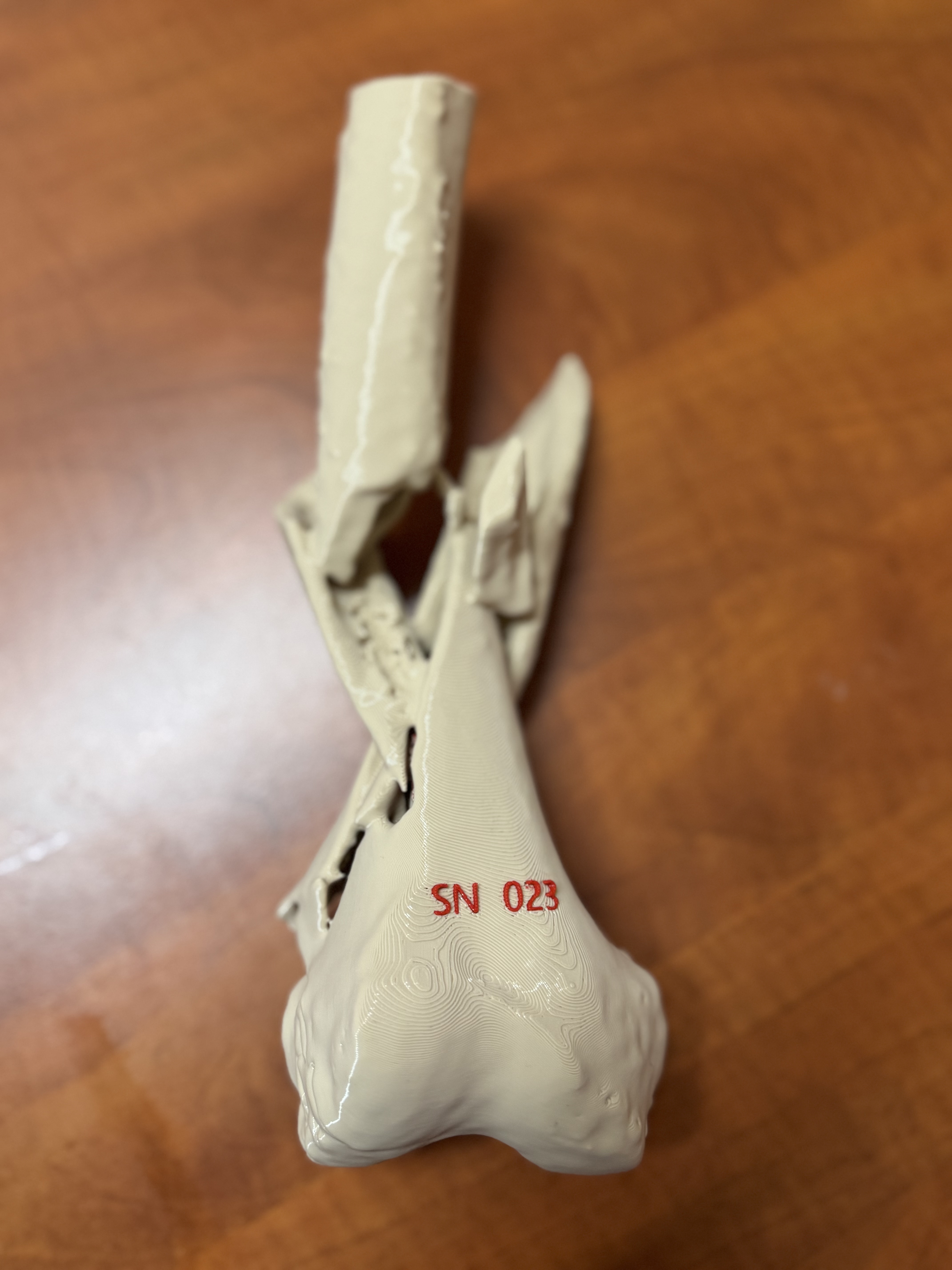 Distal femur fracture