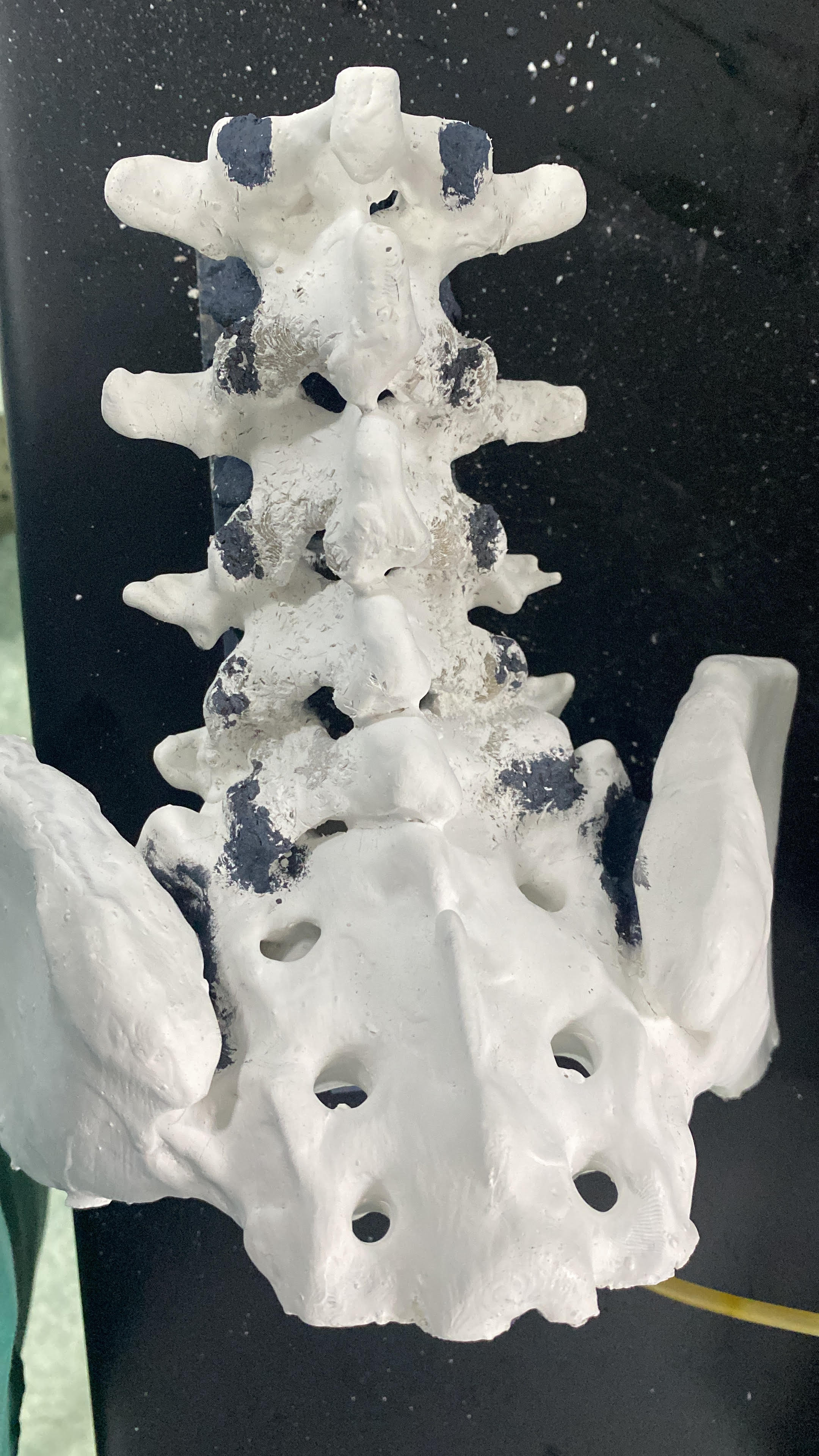 L1-Sacrum-Iliac Model