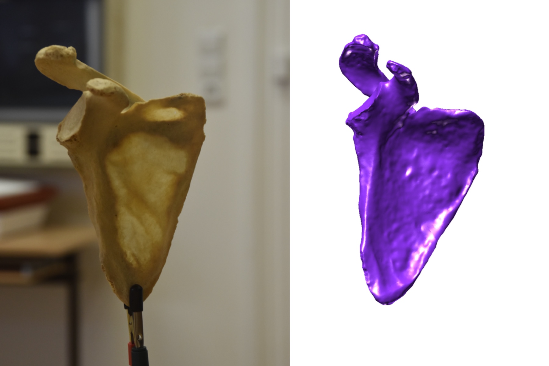 Shoulder Blade Scan - Scapula (R)