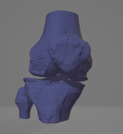 Anatomically correct right knee with degradation