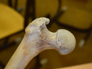 Thigh Bone Scan - Femur by KubiV | Download free STL model | Printables.com