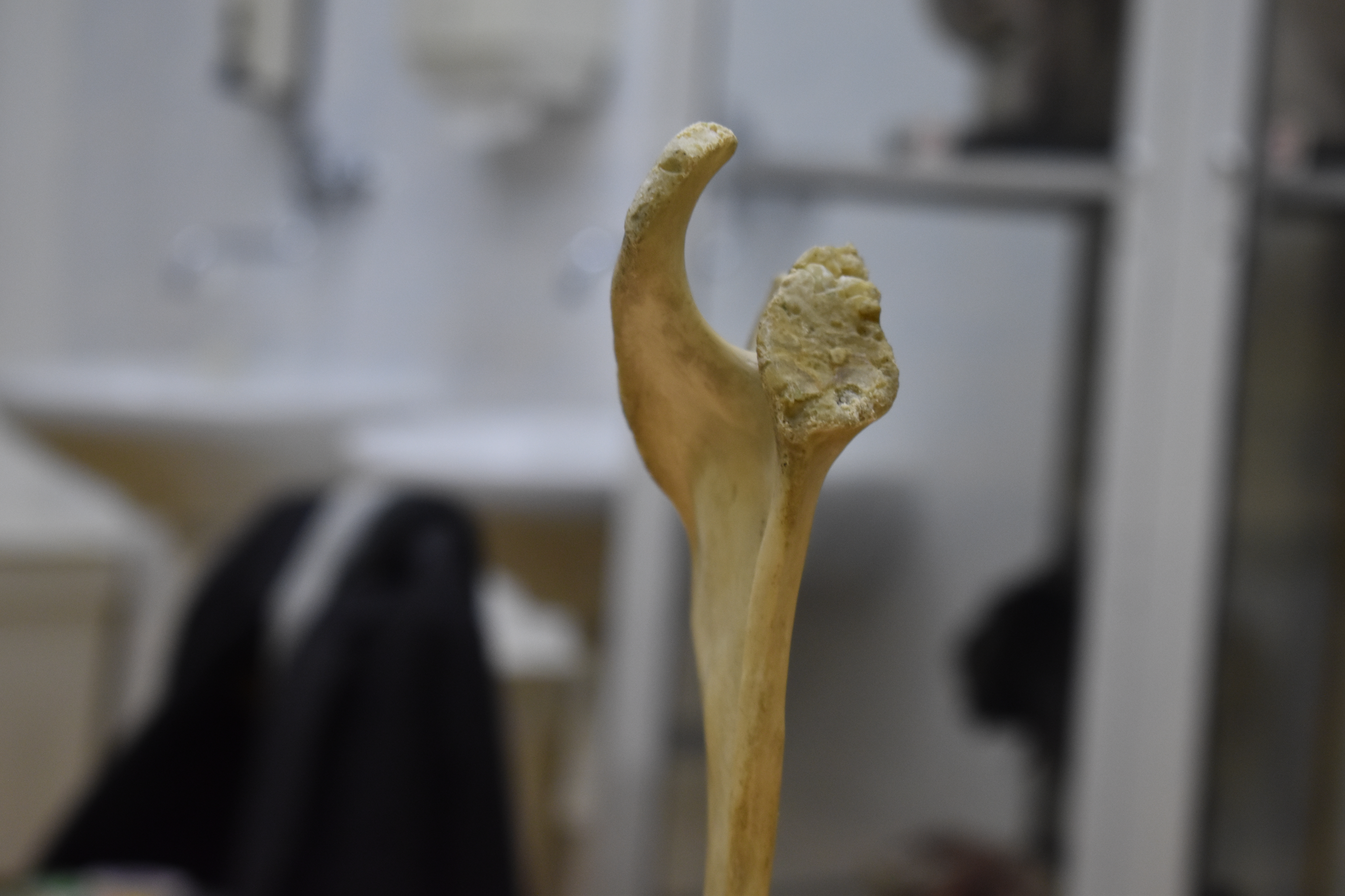 Shoulder Blade Scan - Scapula (R) - Missing Coracoid process — miniatura 4
