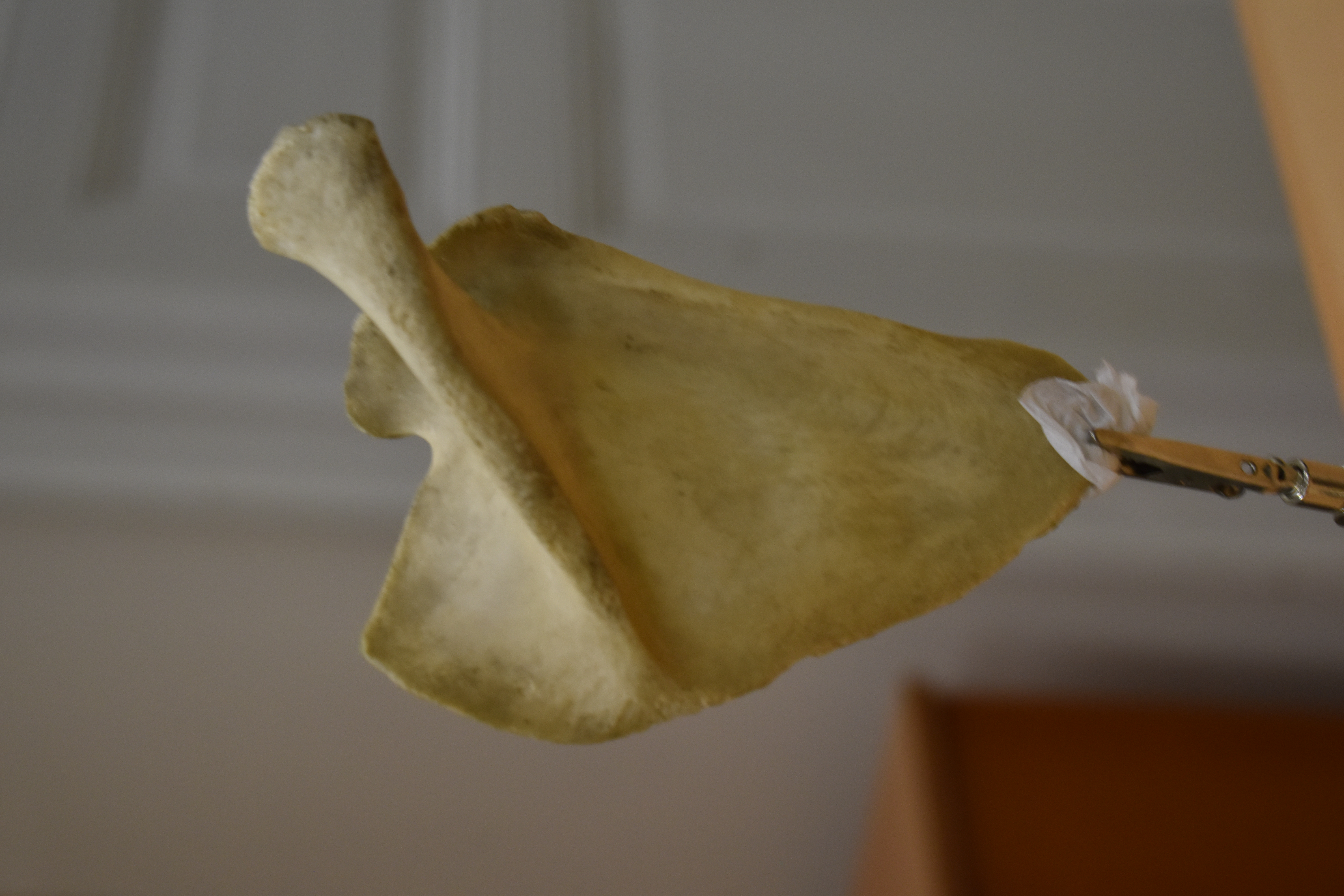 Shoulder Blade Scan - Scapula (R) - Missing Coracoid process — miniatura 5