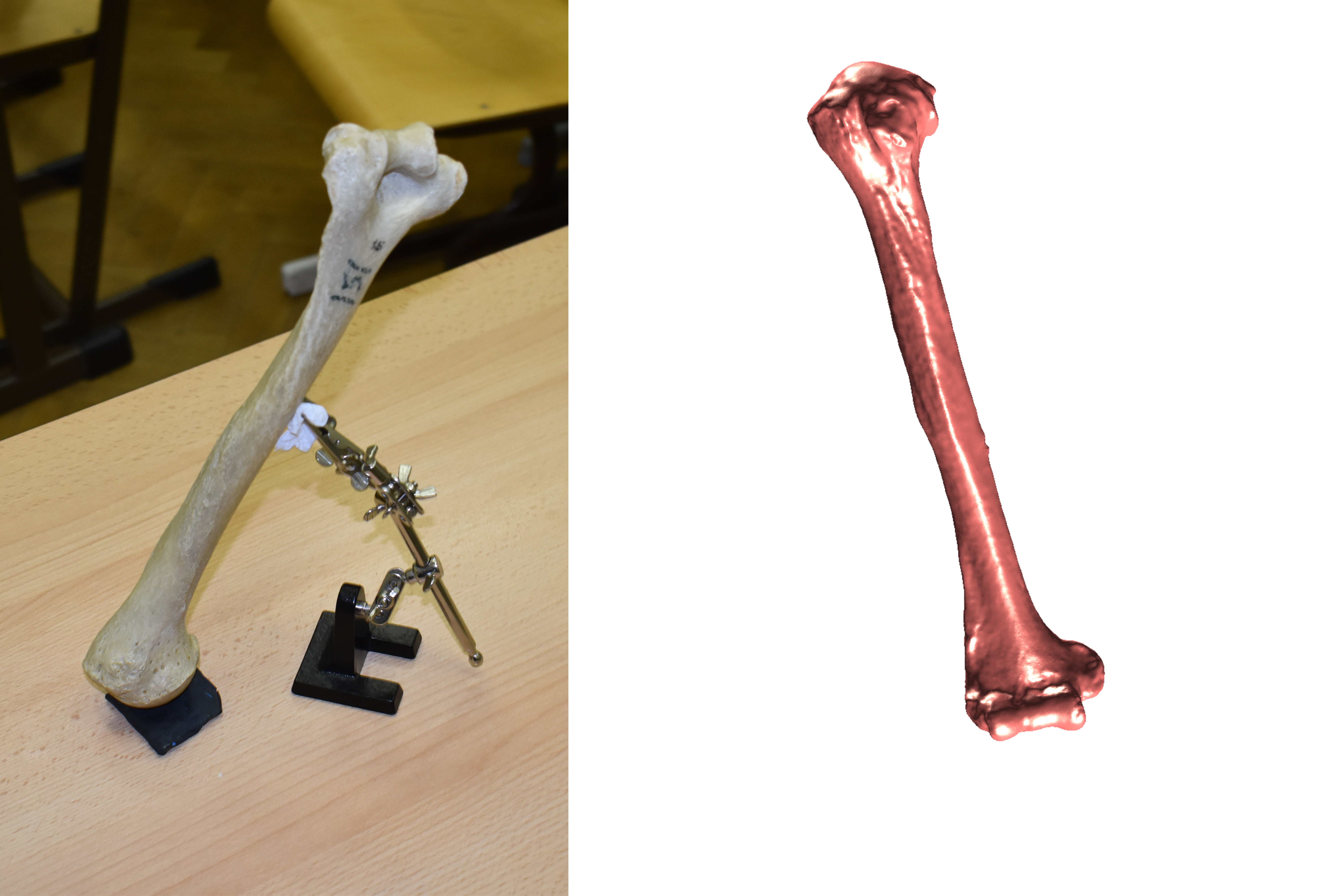 Upper Arm Bone Scan - Humerus (R)