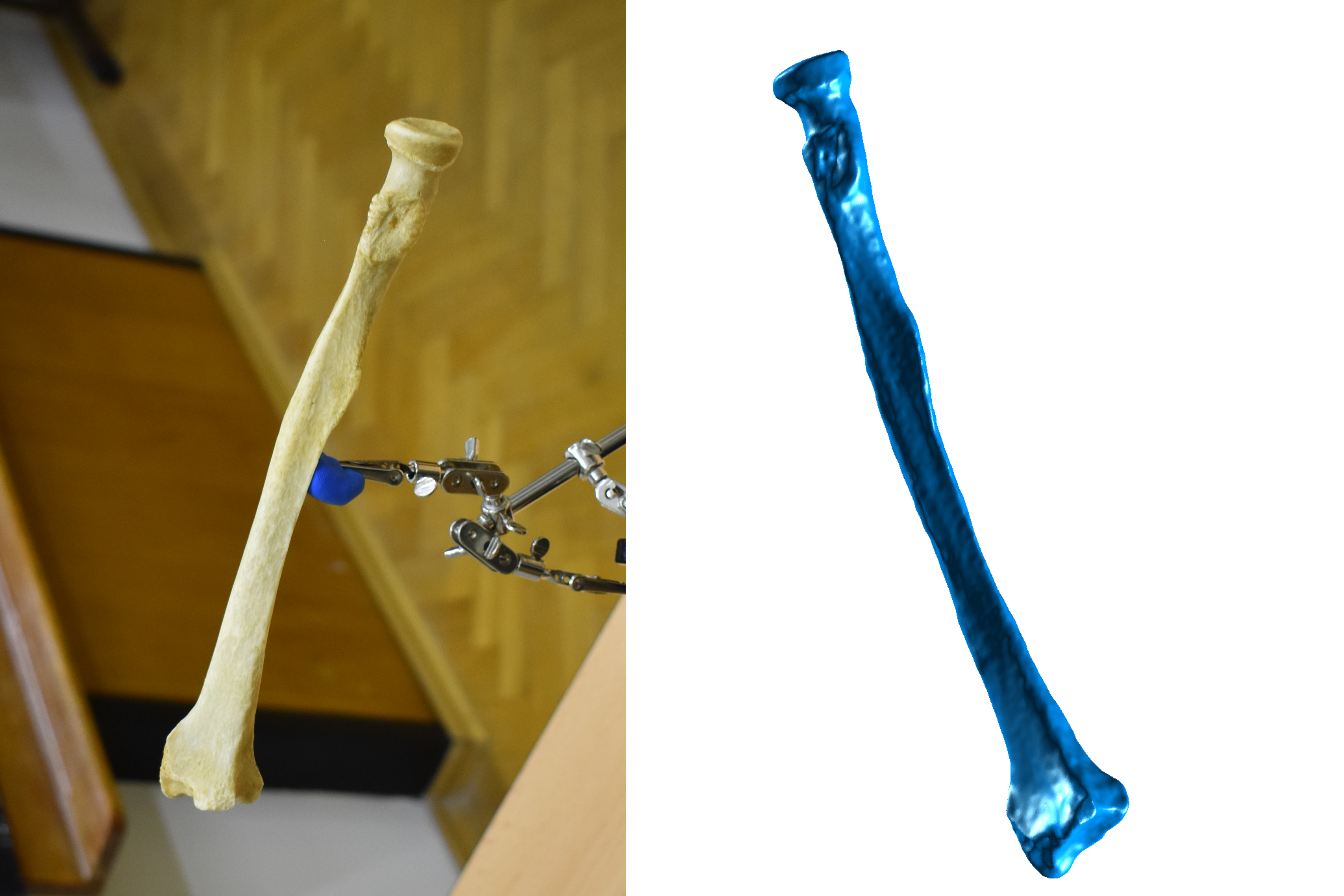 Forearm Bone Scan - Radius (R)