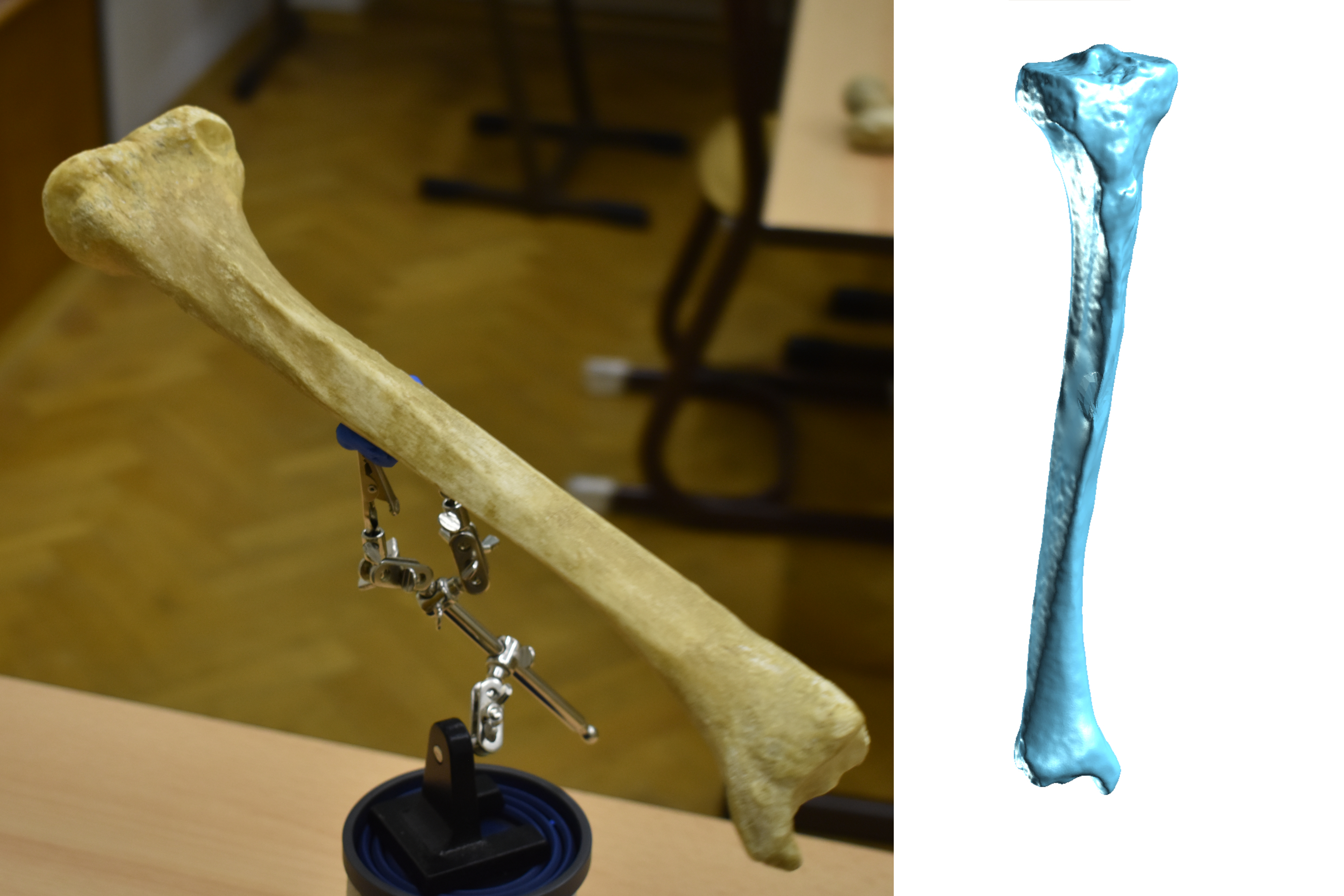 Shinbone  Scan - Tibia (R)