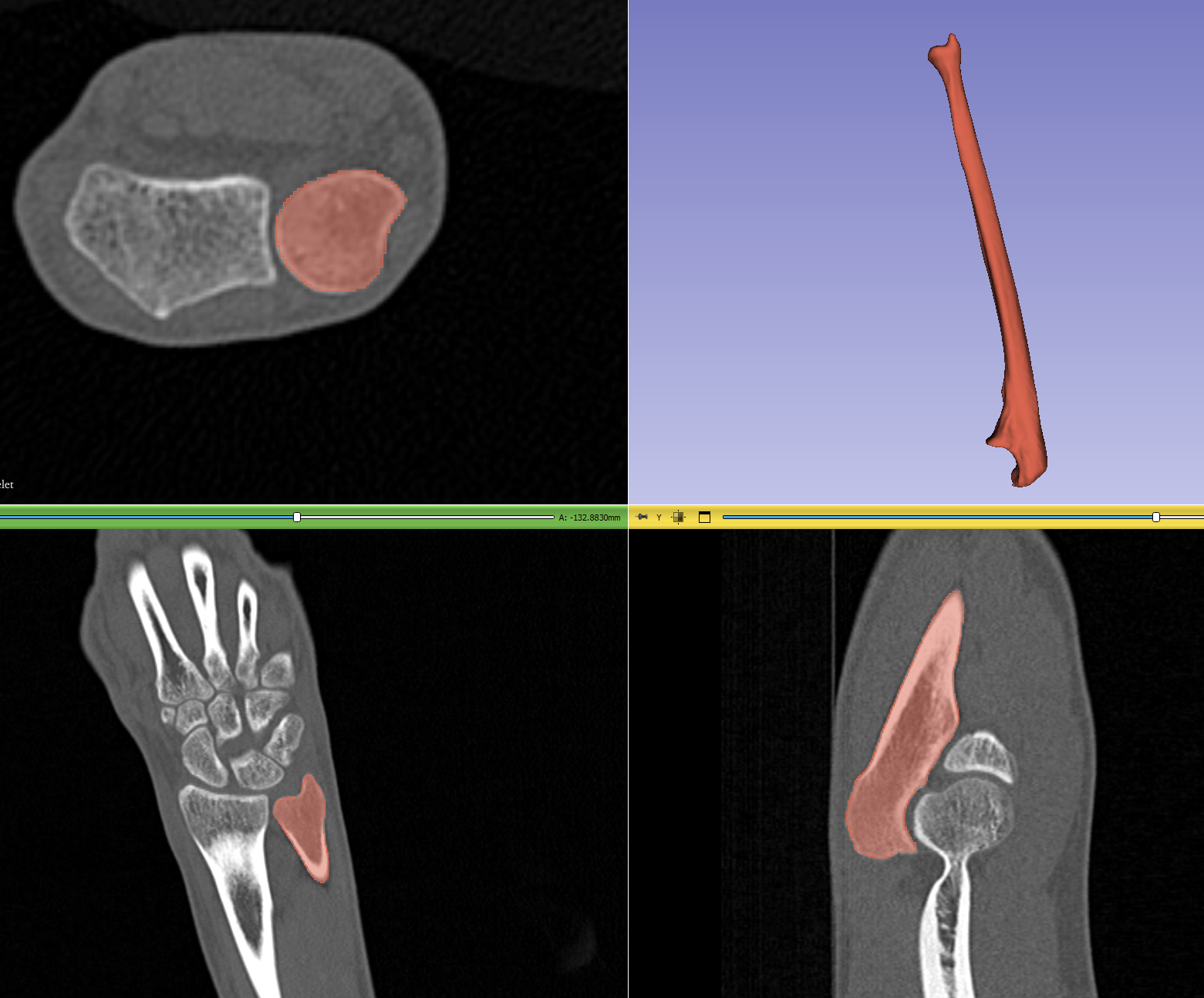 ulna-left-by-karel-p-ni-ka-download-free-stl-model-printables