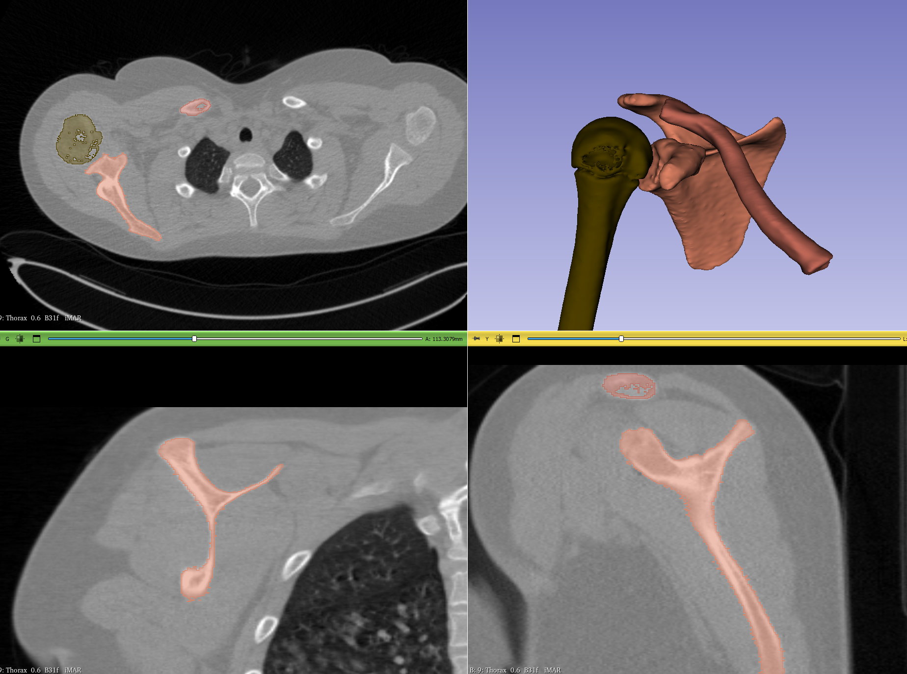 Scapula Right — miniatura 2