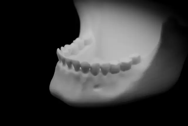 Human Jaw bowl (Pre Supported)