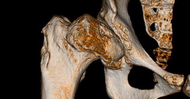 Perthes' disease right hip by sir miss_alot | Download free STL model ...