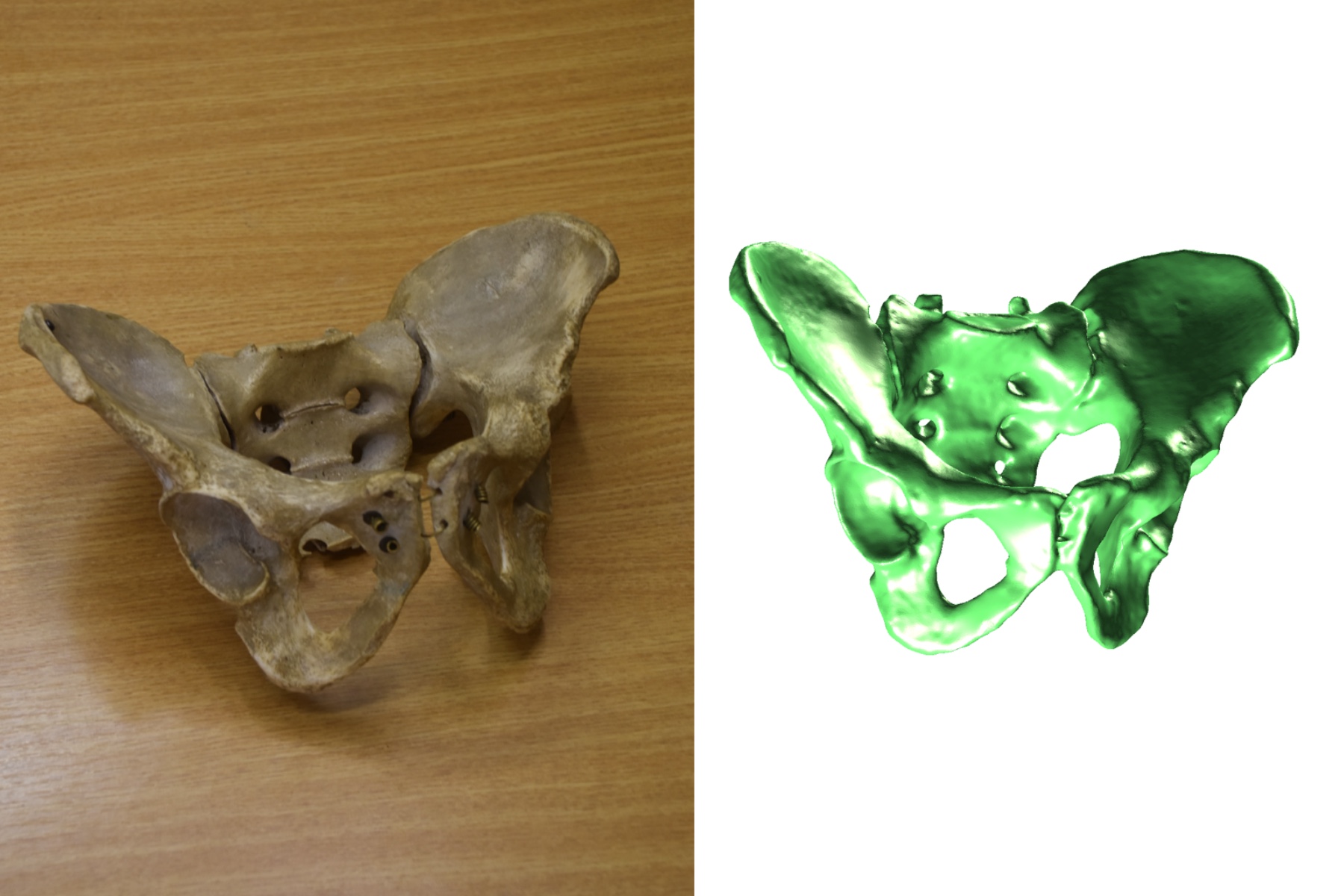 Pelvis Scan - Pelvis
