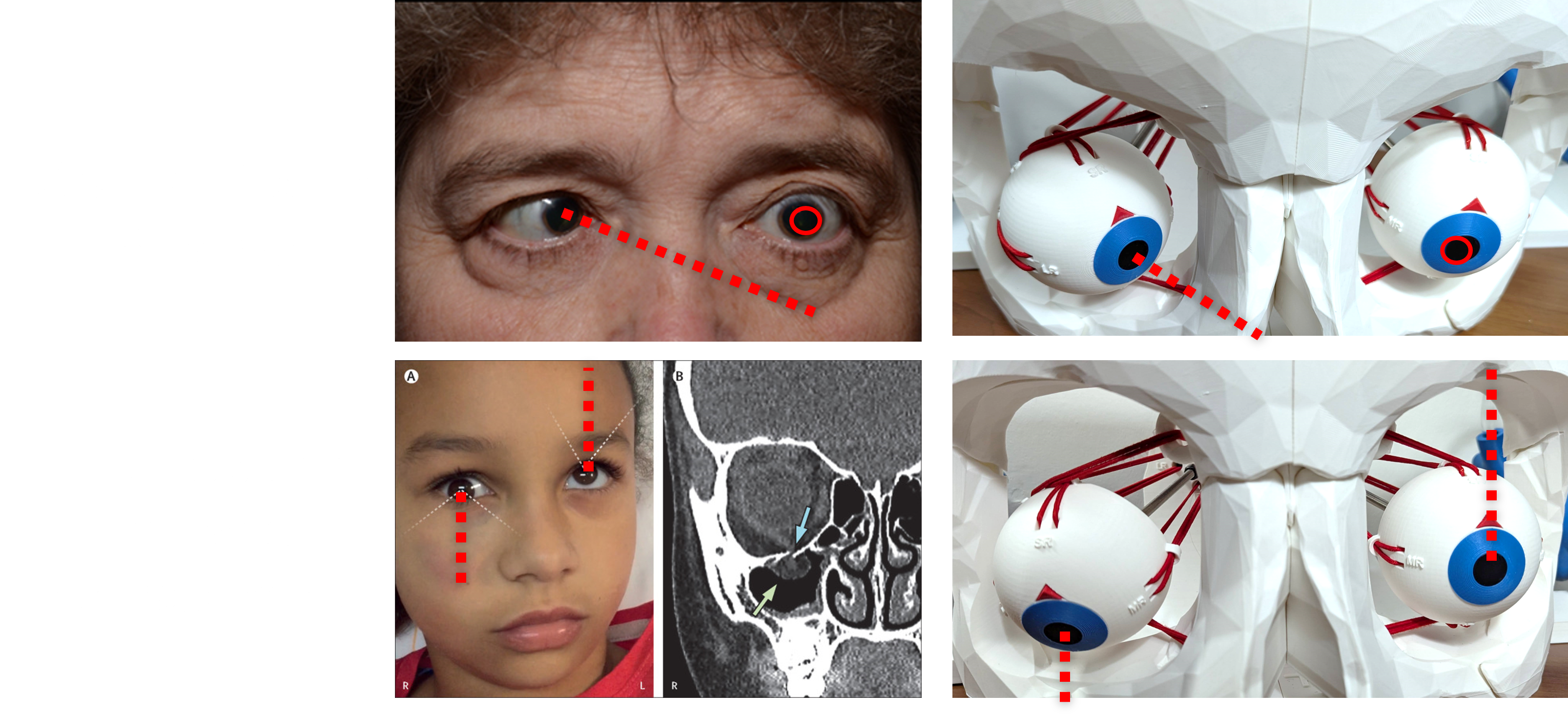 Dynamic Extraocular Muscle Simulator — thumbnail 4