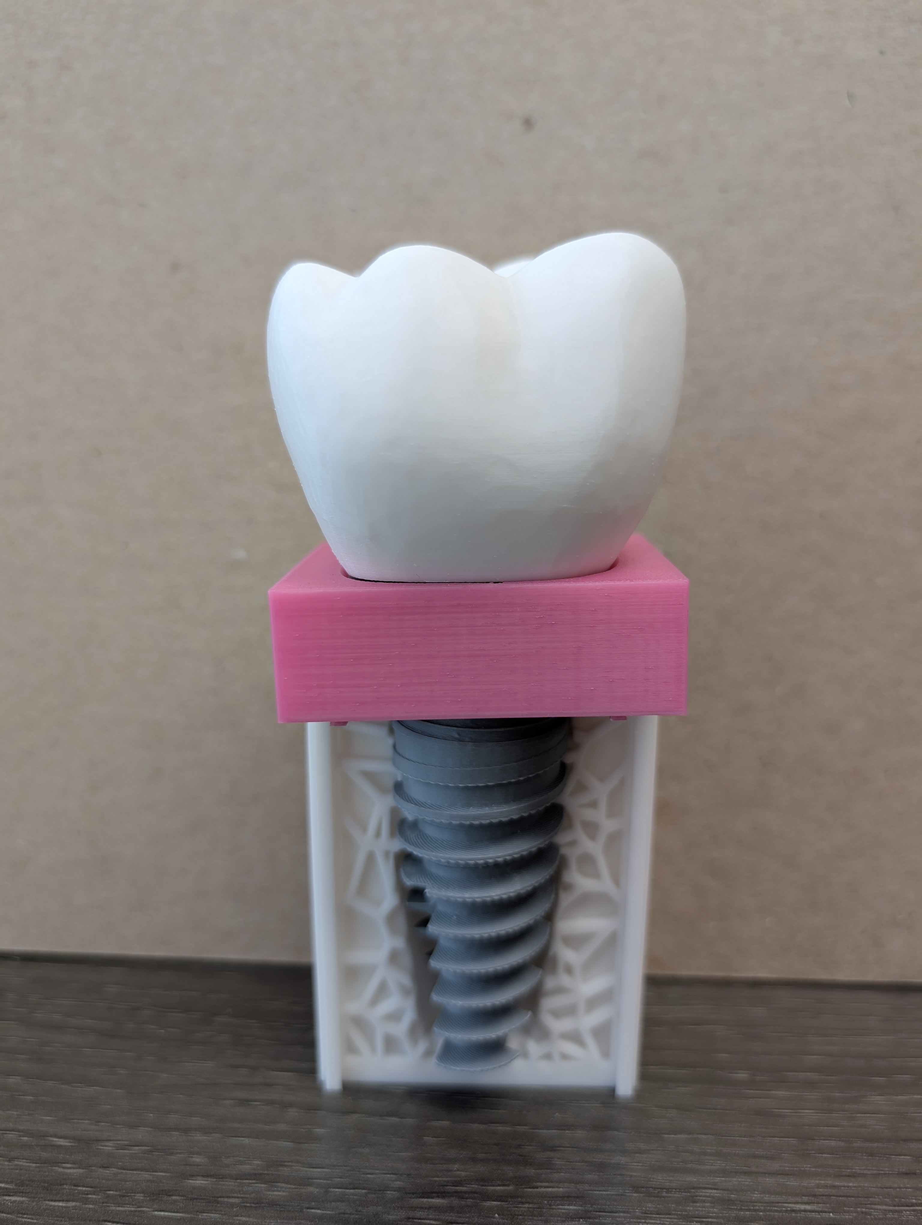 Keon Implant Patient Education/ Dentist Entertainment Model