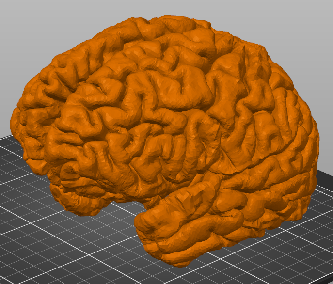 MRI scan of brain