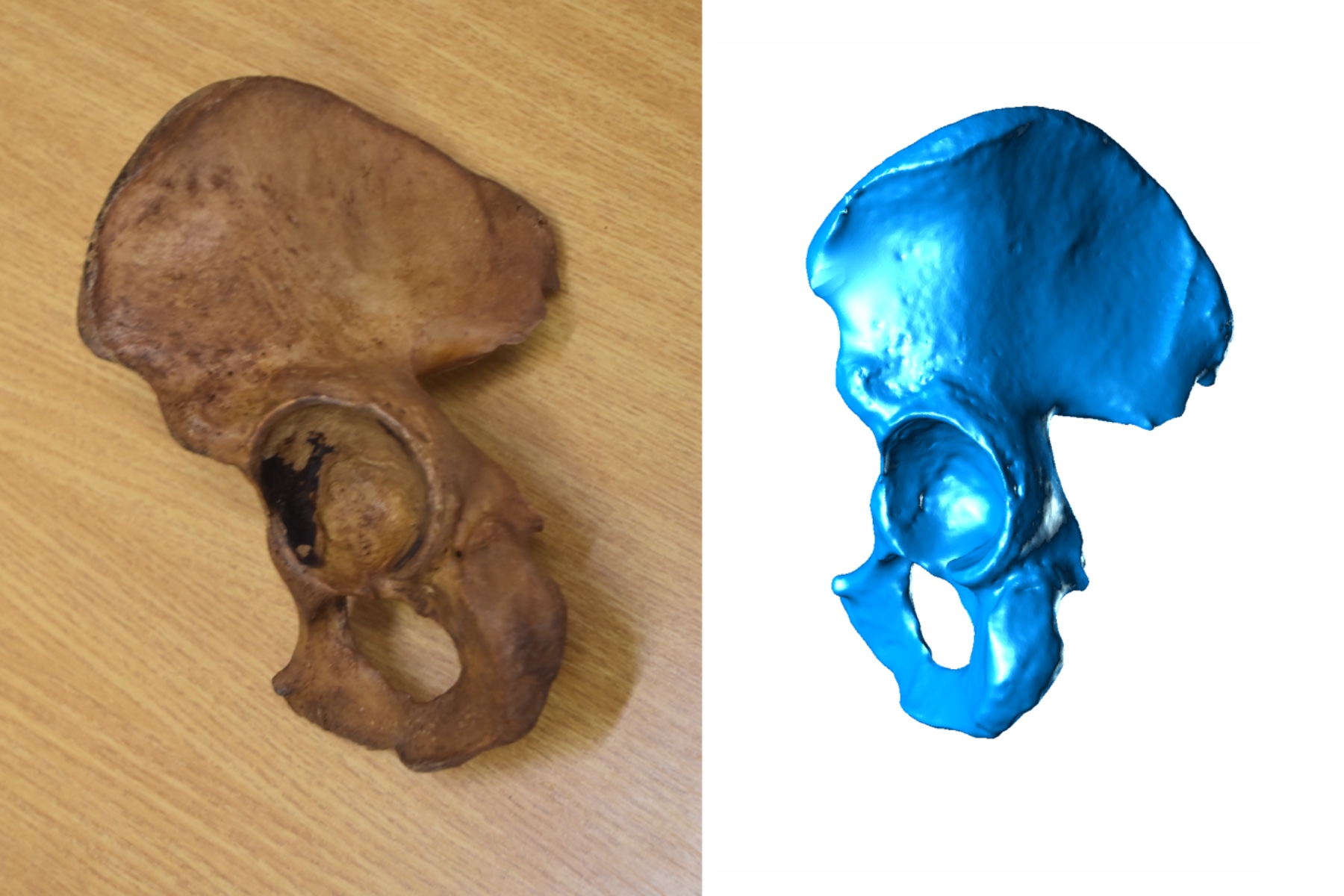 Hip bone Scan - Os Coxae (L)
