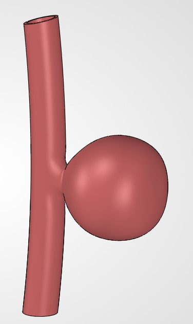 Saccular aneurysm example